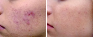 Acne Example