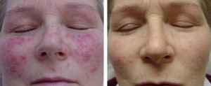 Rosacea example